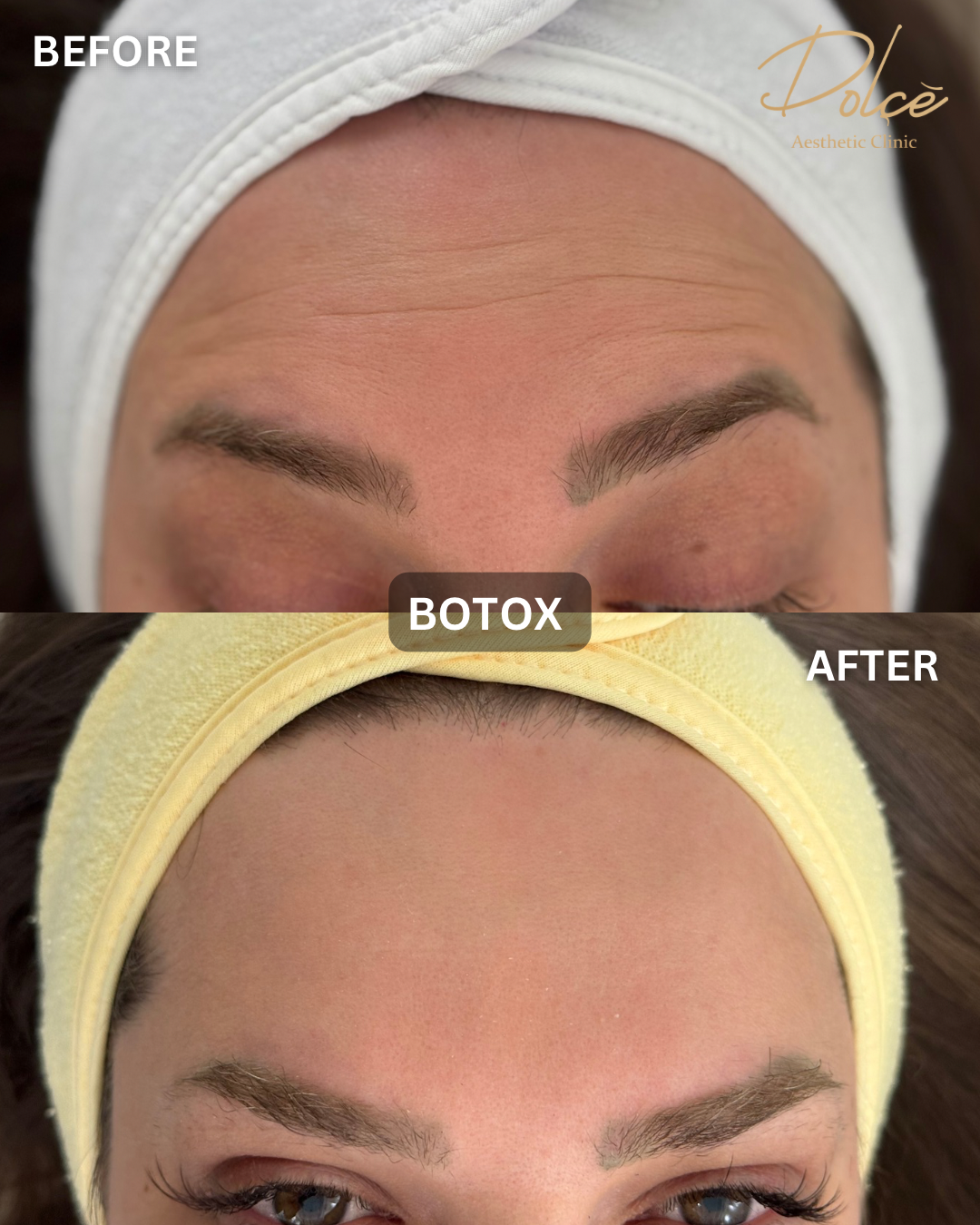 Botox before and after