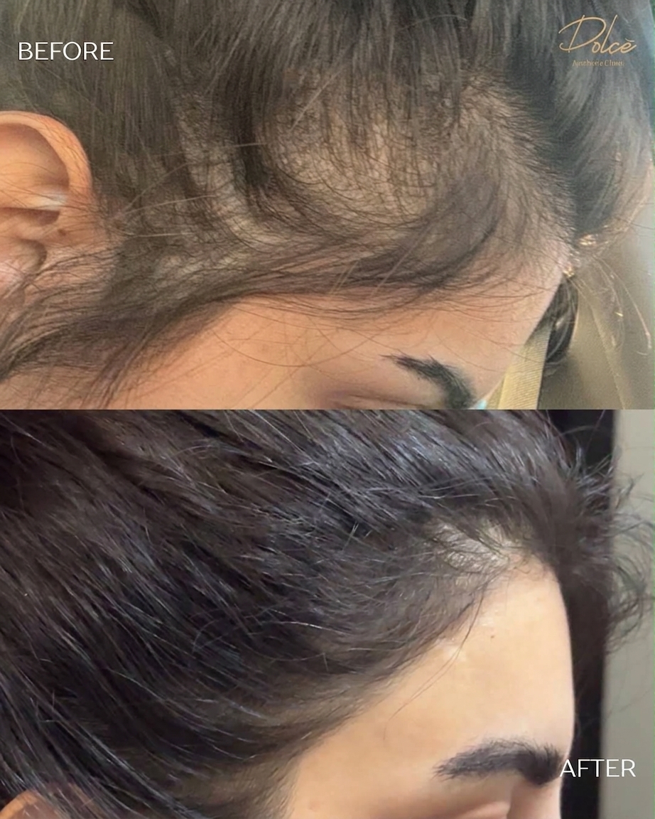 Hair loss PRP treatment, before and after
