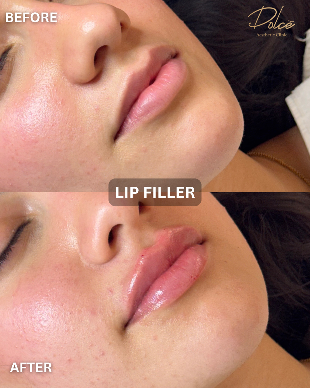 Lip filler before and after