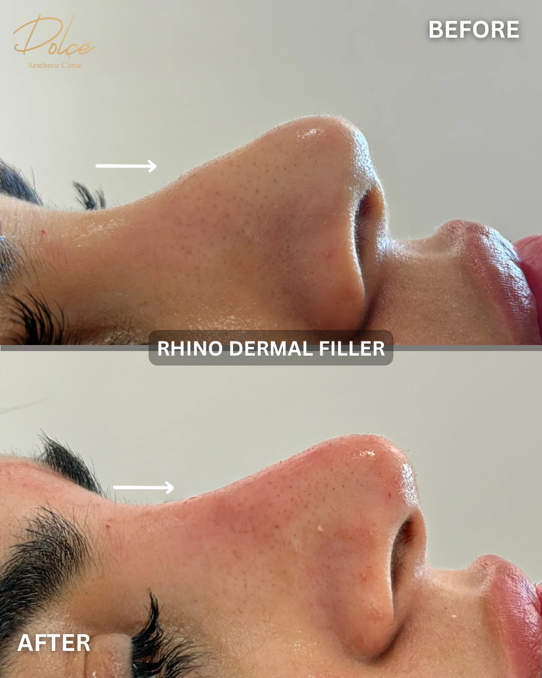 Rhino dermal filler before and after